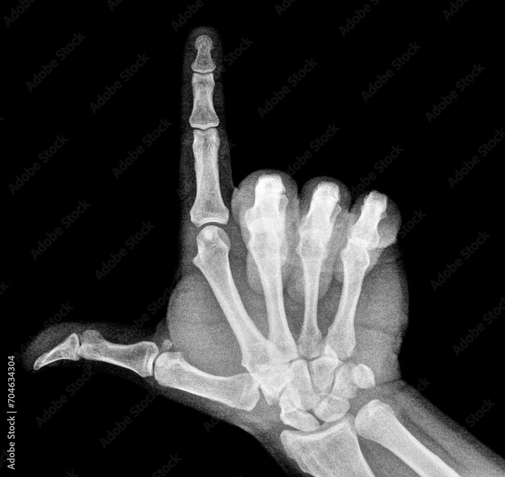 Film xray xray or radiograph of a thumb and finger in gestural