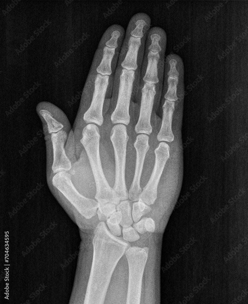 Film xray xray or radiograph of a hand and fingers showing ban, stop