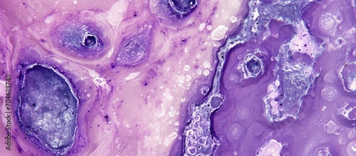 Microscopic histological image of granulomatous mastitis in breast tissue. photo
