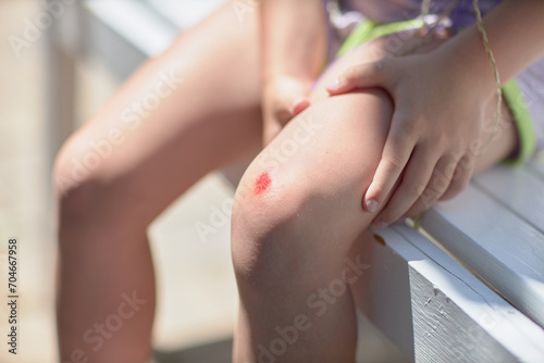 Wounded knee of the child. Abrasion on the lap of baby close-up after the fall. A scratch with blood. Body trauma. photo