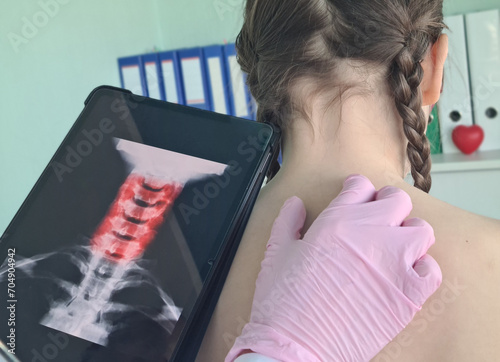 Pediatrician examines x-ray of inflammation of neck and spine in a child photo