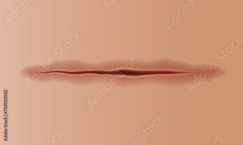 Healing wounds, skin scar, stitched gash and cut. Realistic surgical suture, stitched wounds. Healing stage on human skin background. Vector illustration