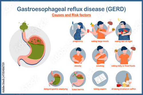 Medical vector illustration in flat style.Causes and risk factors of GERD.Pregnancy,obesity,smoking,eating large meals,eating late at night,hiatal hernia,delayed gastric emptying,drinking alcohol.