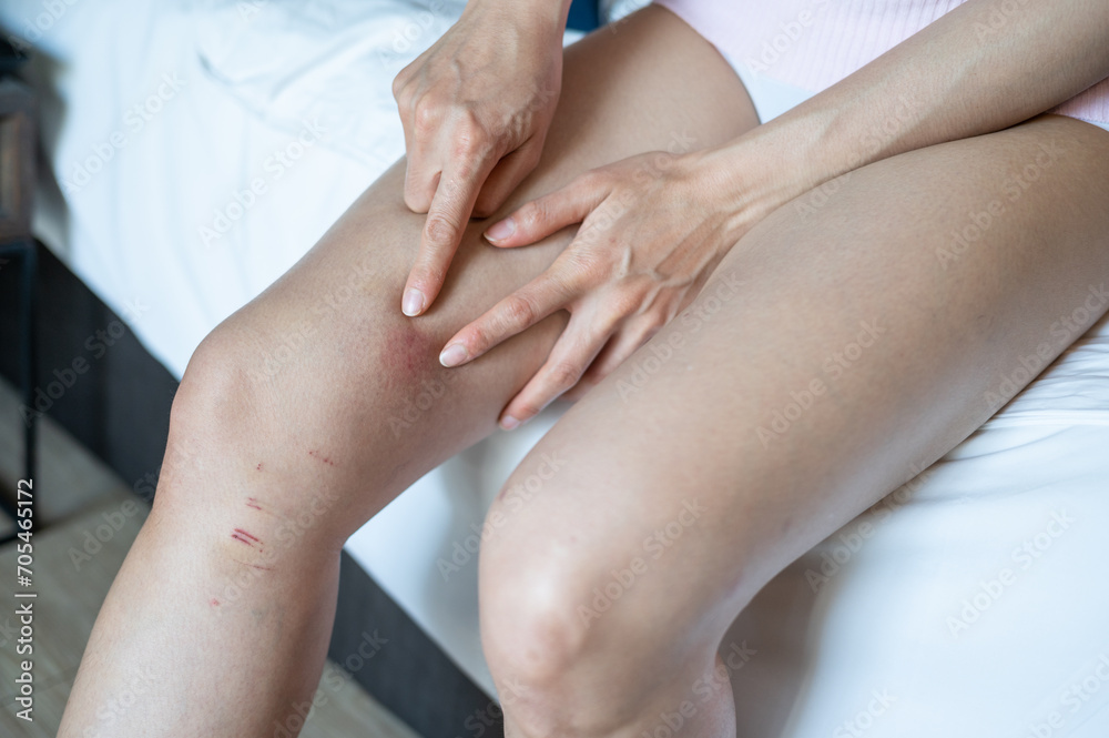 Close up of woman pointing a red rash (or bruise) on her thigh. Rash is a symptom that causes the affected area of skin to turn red and blotchy and to swell. Close up of woman pointing a red rash (or bruise) on her thigh. Rash is a symptom that causes the affected area of skin to turn red and blotchy and to swell.