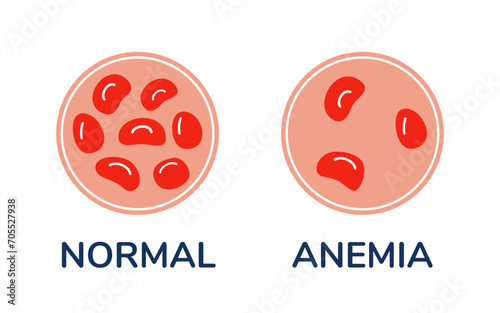 The difference comparison of a drop of blood with normal and anemic cells under microscope vector Medical illustration photo