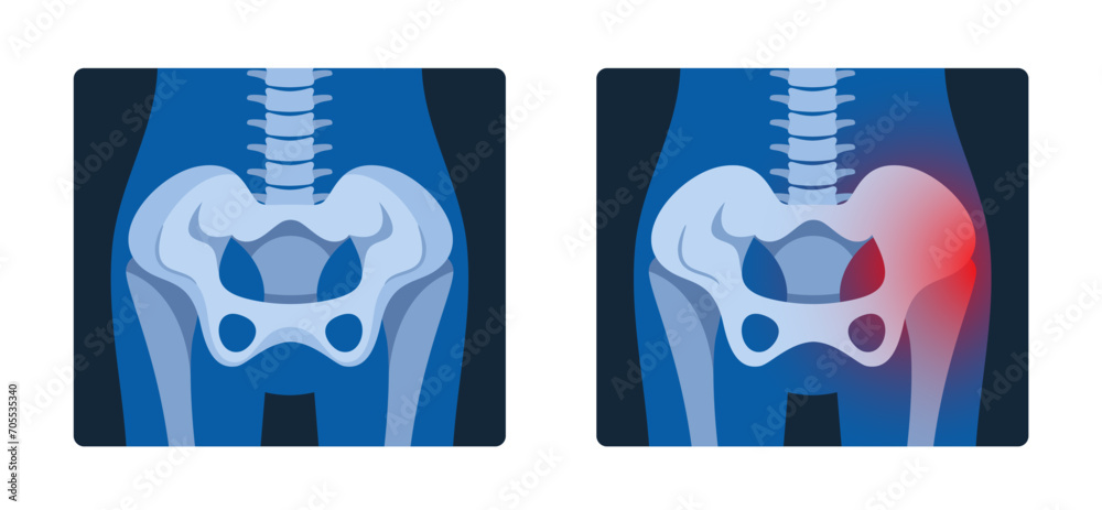 Φωτογραφία X-ray Pictures Of The Pelvis Provide Detailed Images Of The Hip Bones, Sacrum, A