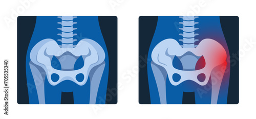 X-ray Pictures Of The Pelvis Provide Detailed Images Of The Hip Bones, Sacrum, And Coccyx, Vector Illustration