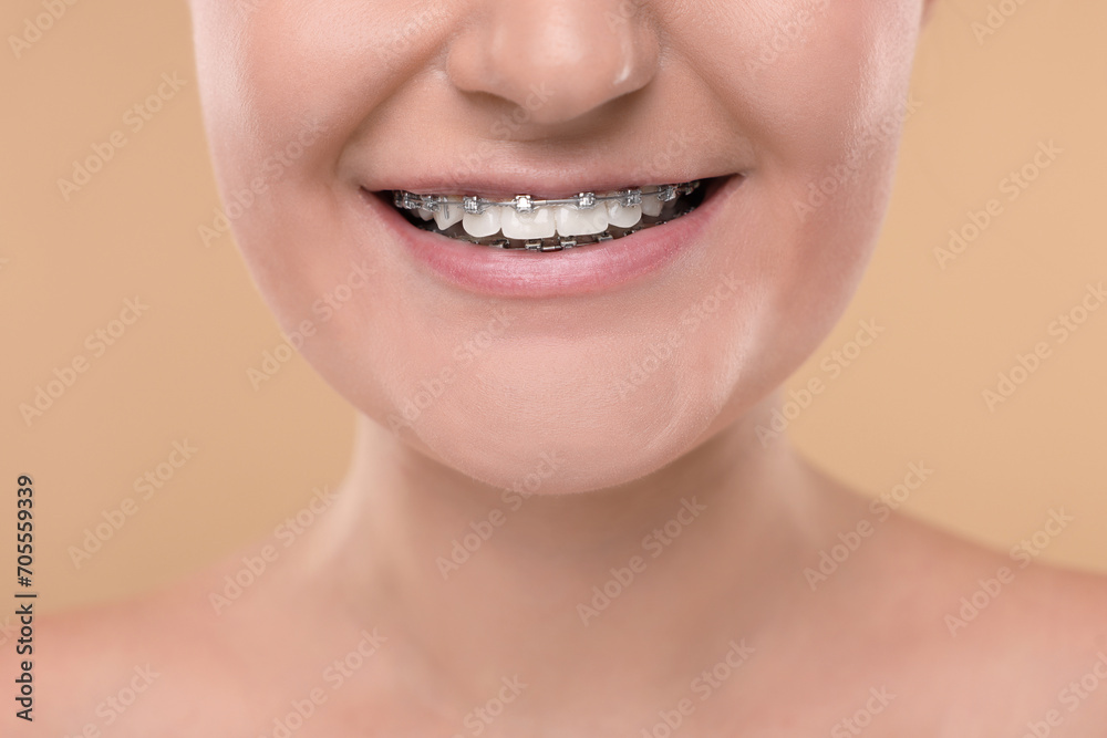 Fototapeta premium Smiling woman with dental braces on beige background, closeup