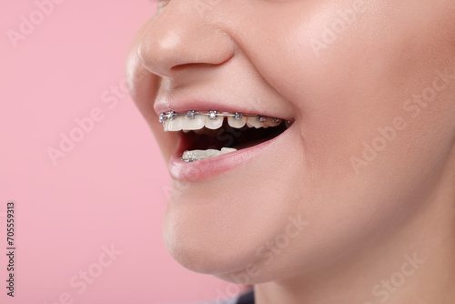 Smiling woman with dental braces on pink background, closeup. Space for text