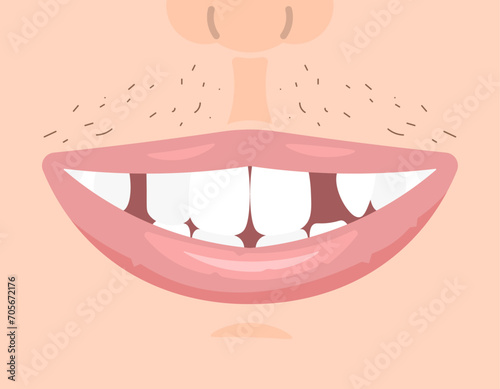 an illustration of a mouth with missing teeth. many teeth are missing and broken. dental condition. health. flat illustration design. graphic elements. vector