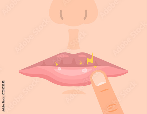 an illustration of the appearance of canker sores in the mouth. mouth sore and inflamed. feels sore because you have canker sores. oral health conditions. flat illustration design. graphic elements
