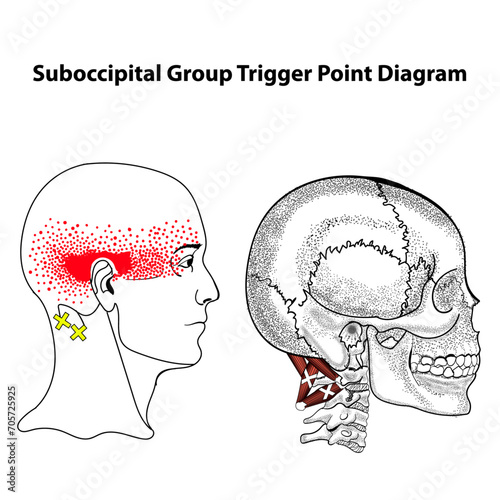 Suboccipital Group Trigger Point Diagram, trapezius, SCM, Levator, Scalenes, and Suboccipital Triangle muscle group. Suboccipital Trigger Point Release and Stretch.