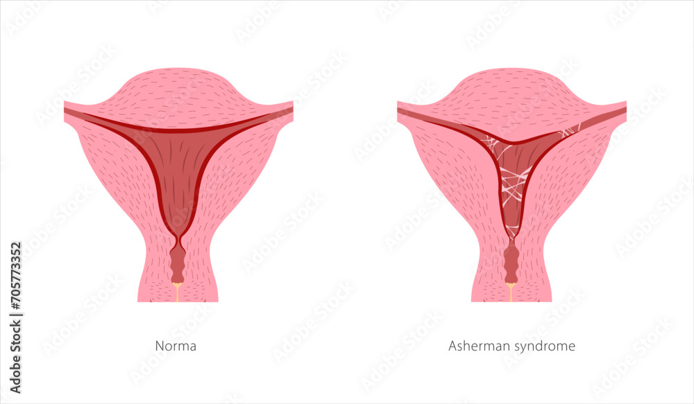 Asherman syndrome female reproductive system. Cross section of uterus ...