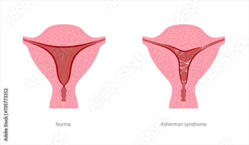 Asherman syndrome female reproductive system. Cross section of uterus with ashesions. Scar tissue in uterine cavity and normal healthy organ. photo