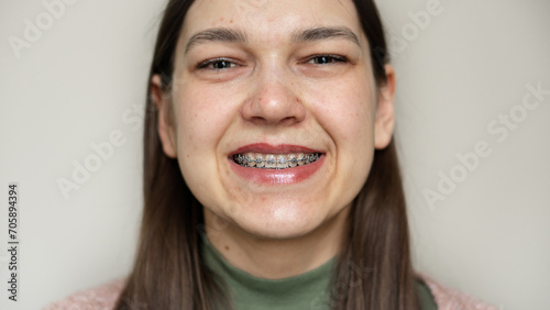 Metal braces on teeth. Orthodontic dental care concept. Woman's smile with braces. photo