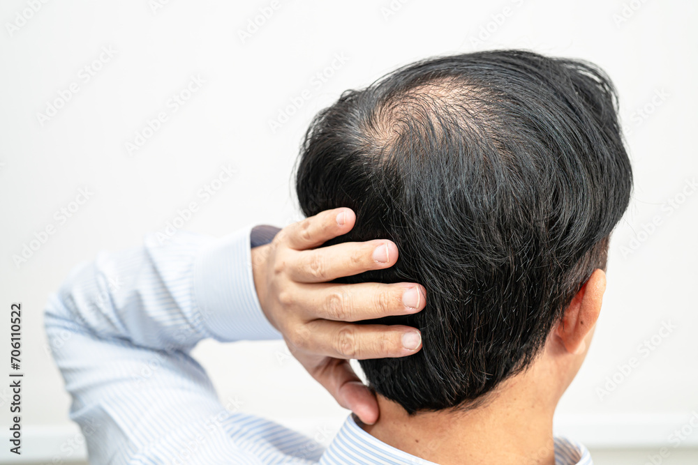 Bald in the middle head and begin no loss hair glabrous of mature Asian business smart active office man. Bald in the middle head and begin no loss hair glabrous of mature Asian business smart active office man.