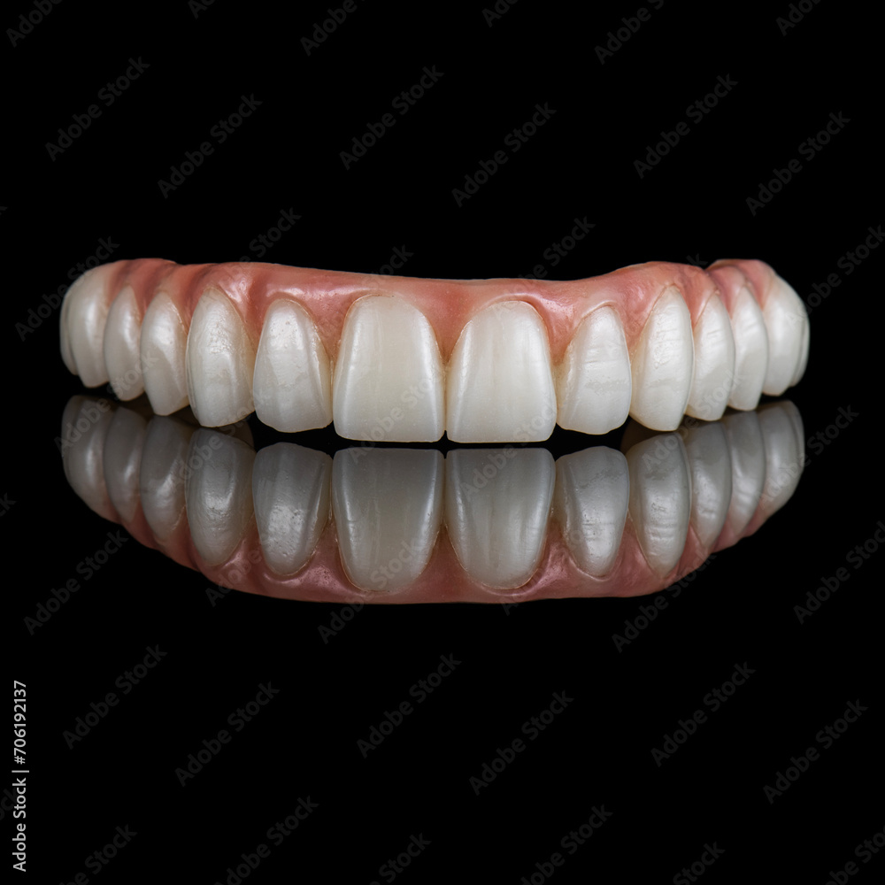 zircon bridge on 8 dental implants zircon bridge on 8 dental implants