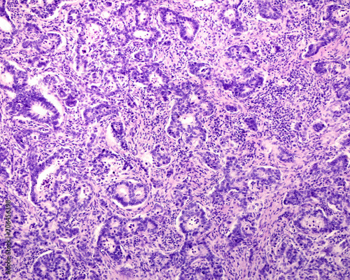 Human prostate cancer. Adenocarcinoma photo