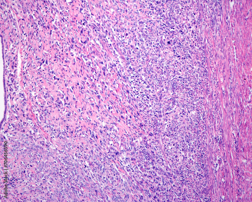 Obraz premium Human uterus. Sarcoma