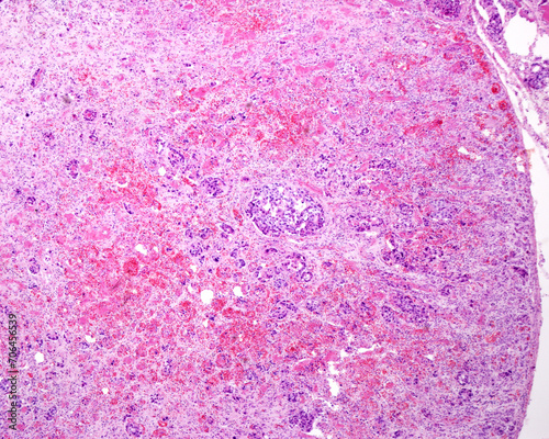 Adrenal cortex carcinoma photo