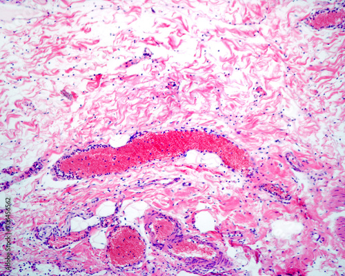 Inflammation. Leukocyte diapedesis photo