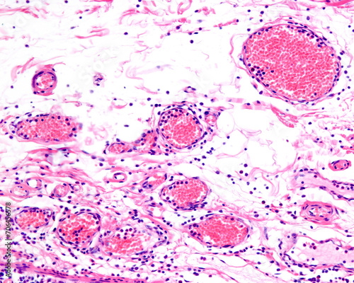 Inflammation. Leucocyte diapedesis photo