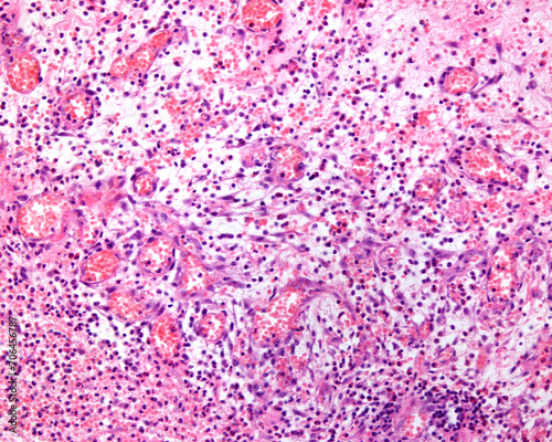 Acute inflammation photo