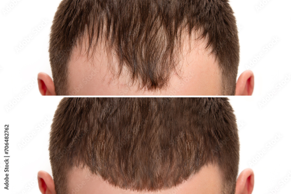Cropped before and after head shot of a young male with bald patches on her forehead and temples. Baldness. Close-up, front view. Hair care and treatment concept. Hair loss, hair extensions, alopecia Cropped before and after head shot of a young male with bald patches on her forehead and temples. Baldness. Close-up, front view. Hair care and treatment concept. Hair loss, hair extensions, alopecia