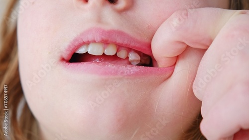 Caucasian Girl Pushing Loose Primary Deciduous Baby Tooth With Tongue