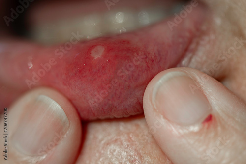 Schilderij op canvas Painful close up of a mouth canker sore ulcer with a shallow depth of field and