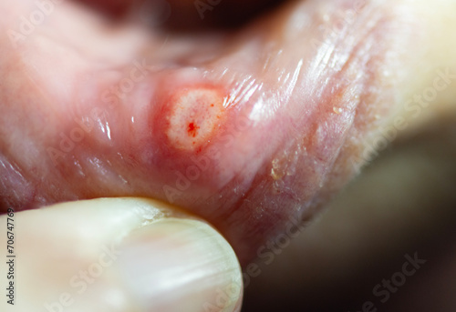 Painful close up of a mouth canker sore ulcer with a shallow depth of field and copy space photo