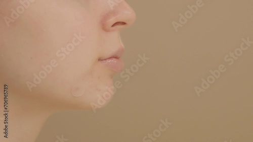 Young woman applies a round patch to a pimple on her face. Concept of the solution for acne problems. Close-up of face of unrecognizable woman on beige background, copy space. photo