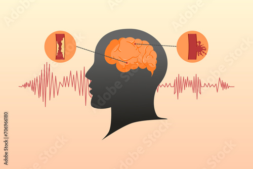 Stroke disease concept. Ischemic and hemorrhagic. Scientific medical illustration of human brain stroke. Vector illustration.