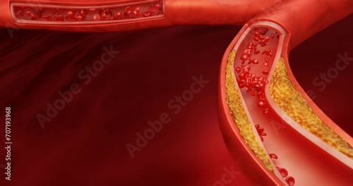 Expansion fat in the blood vessels. Hyperlipidemia or arteriosclerosis. human blood vessel disease with cholesterol fat buildup clogging. Clogged arteries, Cholesterol plaque artery. 3d rendering photo