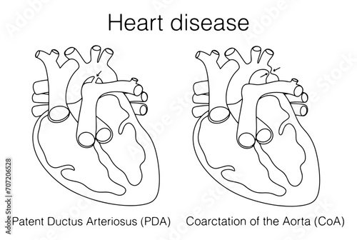 Heart. Patent Ductus Arteriosus. Coarctation of the aorta photo