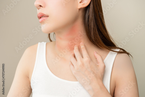 Dermatology concept, asian young woman, girl allergy, allergic reaction from atopic, insect bites on her neck, hand in scratching itchy, itch red spot or rash of skin. Health care, treatment of beauty