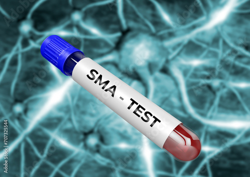 Blood sample for diagnosis of Spinal Muscular Atrophy SMA, a neurodegenerative disease. photo