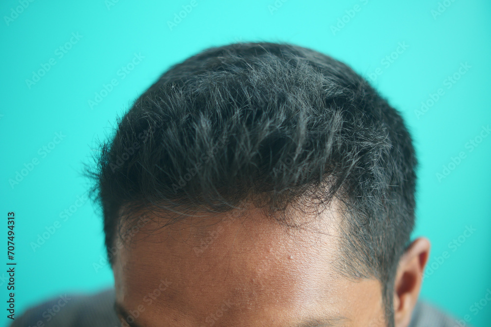 Obraz premium hair loss concept with man checking his hair 
