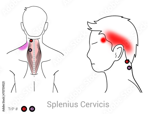 Splenius Cervicis: Myofascial trigger points and associated pain locations photo