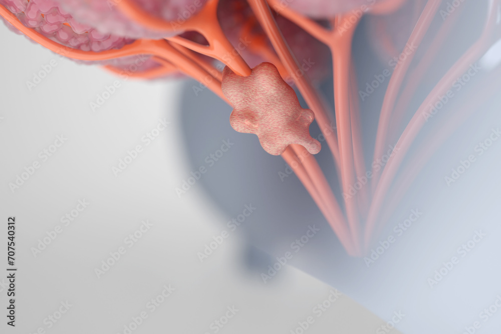 Close-up, Woman's chest reveals breast cancer cells, illustrating the concept of radiotherapy treatment for effective intervention. 3D rendering. Close-up, Woman's chest reveals breast cancer cells, illustrating the concept of radiotherapy treatment for effective intervention. 3D rendering.