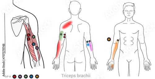 Triceps brachii: Myofascial trigger points and associated pain locations photo