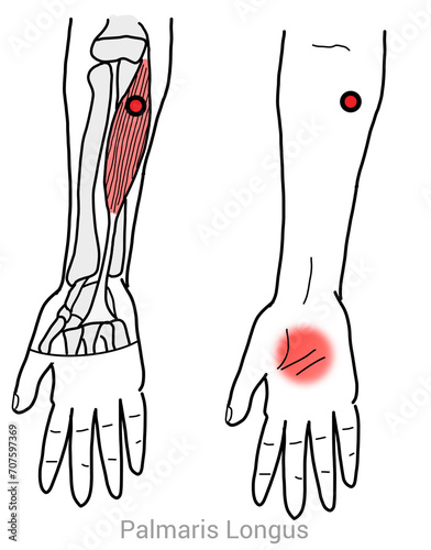 Palmaris Longus: Myofascial trigger points and associated pain locations photo