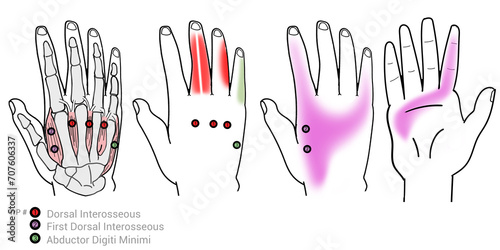 Dorsal Interosseous: Myofascial trigger points and associated pain locations photo