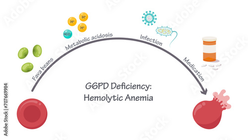 G6PD Deficiency Hemolytic Anemia medical vector illustration graphic photo