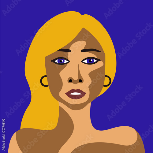 Young woman with skin disease vitiligo with European appearance in minimalist style