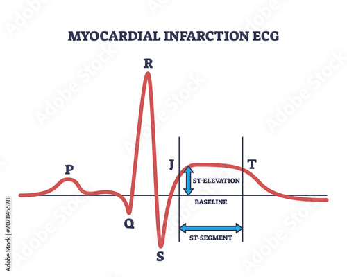 Myocardial infraction ECG with abnormal ST segment elevation outline diagram. Labeled educational scheme with medical example of heart rate abnormality vector illustration. Heart pulse cardiac issue.