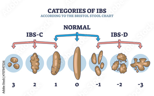 Categories of IBS stages according to bristol stool chart outline diagram. Labeled educational scheme with normal and abnormal excrement structures vector illustration. Digestive health conditions. photo