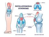 Patellofemoral pain syndrome as anatomical knee condition outline diagram. Labeled educational scheme with leg kneecap patella part inflammation vector illustration. Joint quadriceps tendon location