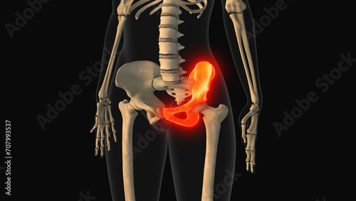 Medical animation of the hip bone pain photo