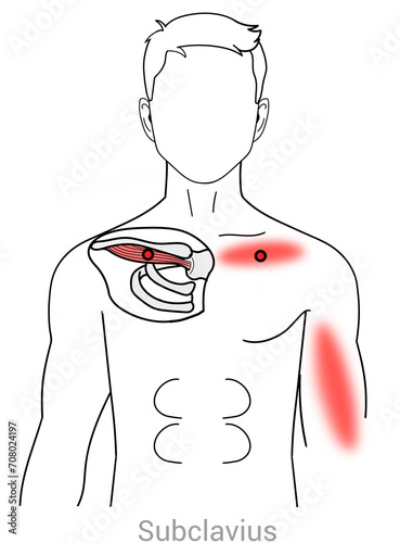 Subclavius: Myofascial trigger points and associated pain locations photo